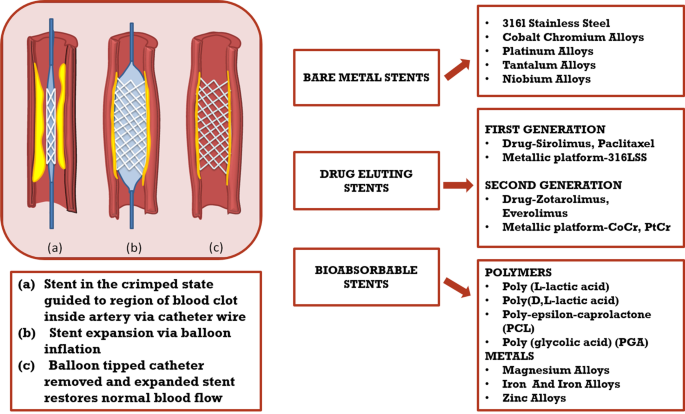 Balloon expandable coronary stent materials: a systematic review 