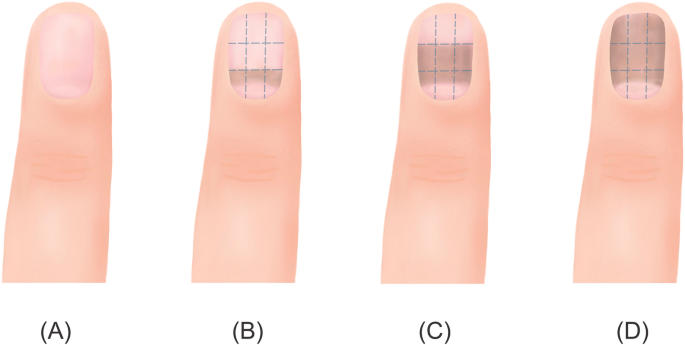 Nail pigmentation induced by chemotherapy: an observational study of patients with early-stage breast cancer | SpringerLink Nail pigmentation induced by chemotherapy: an observational study of patients with early-stage breast cancer | SpringerLink