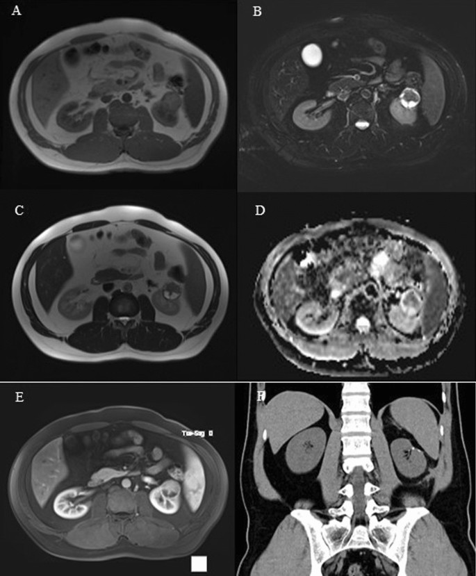 Eosinophilic solid and cystic renal cell carcinoma: a case report of a ...