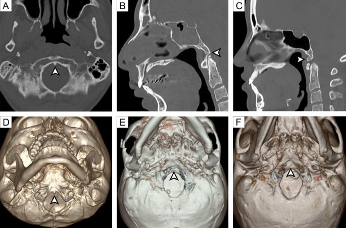 Radiological Assessment of Clival Morphological Variants in the Thai ...