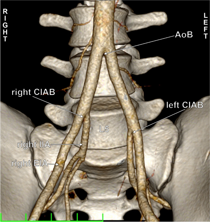 the-aortic-and-iliac-bifurcations-a-detailed-anatomo-imaging-study