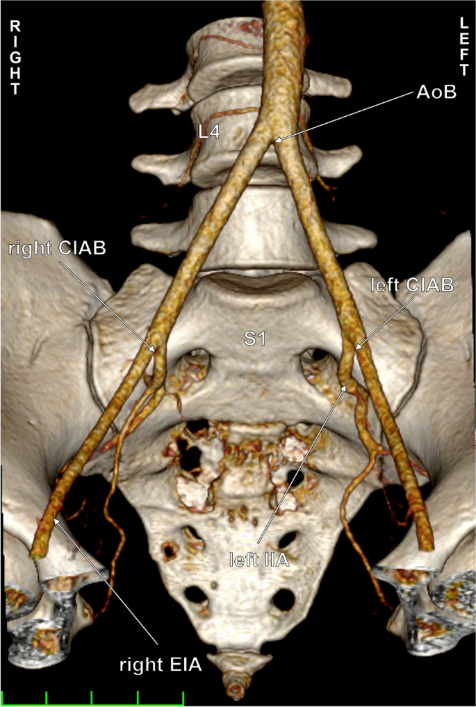 the-aortic-and-iliac-bifurcations-a-detailed-anatomo-imaging-study