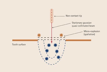 Laser-tissue interaction | British Dental Journal