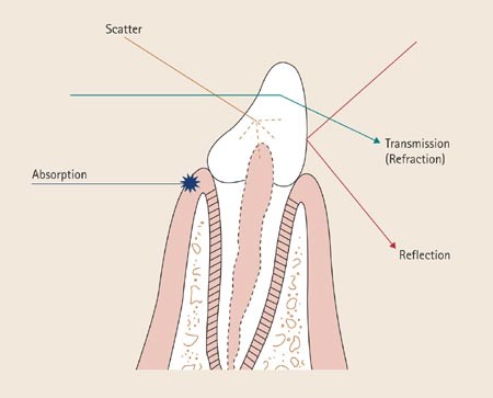 Laser-tissue interaction | British Dental Journal