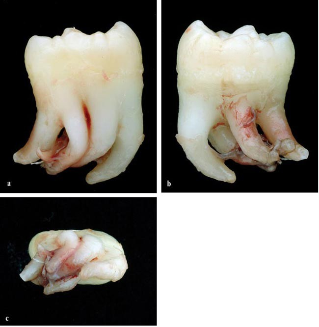 Tooth Fusion Vs Gemination: Unraveling Dental Mysteries