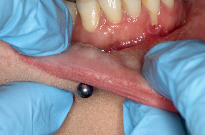 Oral Health & Piercings In 2024 - ToothShower