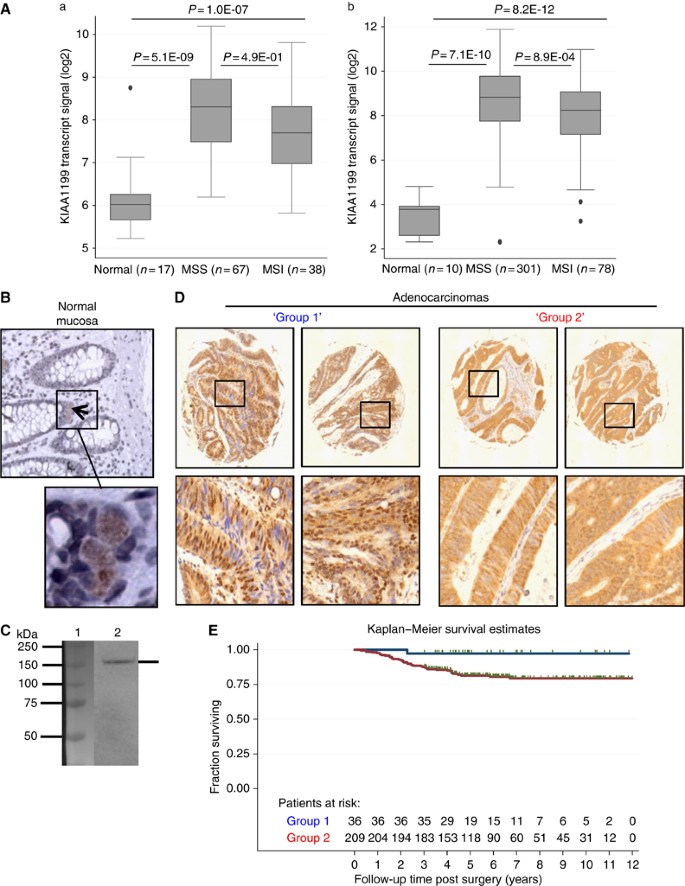 Repression of KIAA1199 attenuates Wnt-signalling and decreases the  proliferation of colon cancer cells | British Journal of Cancer