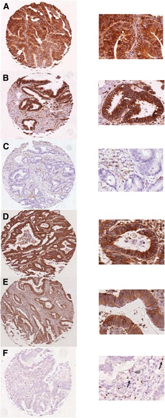 Combined Analysis Of Hla Class I Hla E And Hla G Predicts Prognosis In Colon Cancer Patients British Journal Of Cancer