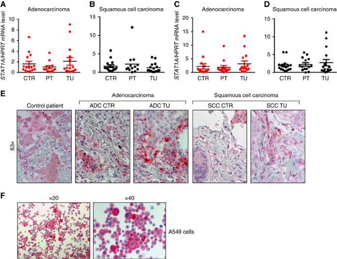 Impaired T-bet-pSTAT1α and perforin-mediated immune responses in the  tumoral region of lung adenocarcinoma | British Journal of Cancer