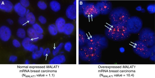 Prognostic value of a newly identified MALAT1 alternatively spliced  transcript in breast cancer | British Journal of Cancer