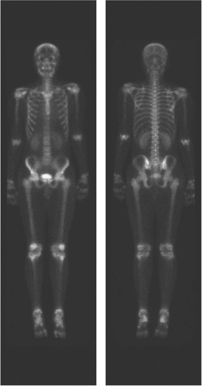 Clinical Features Of Calcineurin Inhibitor Induced Pain Syndrome After Allo Sct Bone Marrow Transplantation