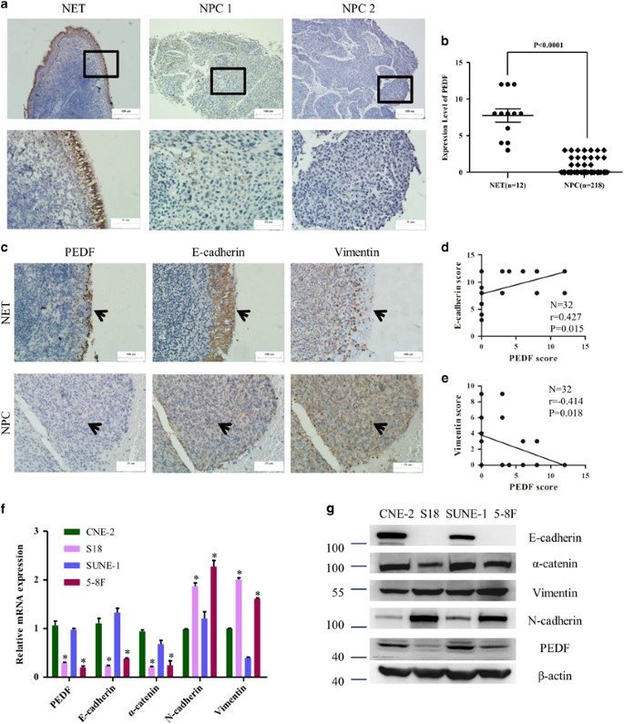 Deficiency of pigment epithelium-derived factor in nasopharyngeal carcinoma  cells triggers the epithelial–mesenchymal transition and metastasis | Cell  Death & Disease