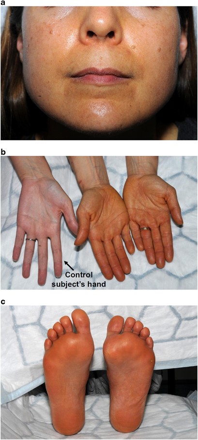 Carotenoderma in a young woman of normal body mass index with hypothalamic  amenorrhoea: a 2-year follow-up case report | European Journal of Clinical  Nutrition