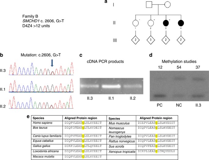 Identification Of Two Novel Smchd1 Sequence Variants In Families With Fshd Like Muscular Dystrophy European Journal Of Human Genetics