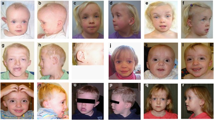 Pias4 Is Associated With Macro Microcephaly In The Novel Interstitial 19p13 3 Microdeletion Microduplication Syndrome European Journal Of Human Genetics
