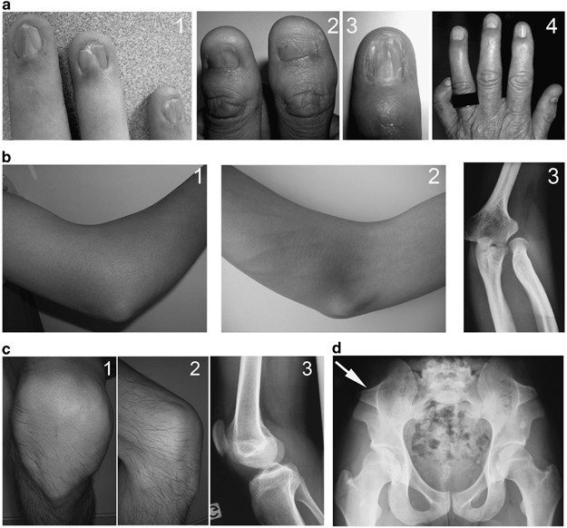 Nail–Patella Syndrome: clinical and molecular data in 55 families raising  the hypothesis of a genetic heterogeneity | European Journal of Human  Genetics