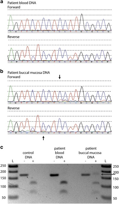 Mosaic CREBBP mutation causes overlapping clinical features of Rubinstein– Taybi and Filippi syndromes