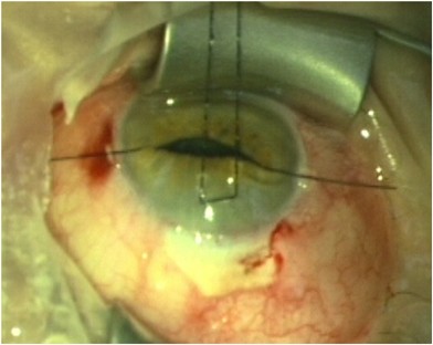 Floppy Iris Syndrome Hull Hooks (FISH Hooks): a new technique for managing  IFIS in trabeculectomy surgery