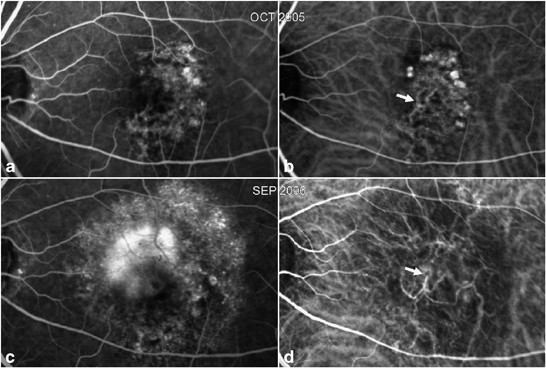 Polypoidal choroidal vasculopathy: an angiographic discussion | Eye