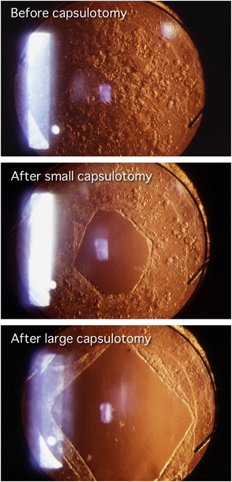 Influence of size of neodymium:yttrium-aluminium-garnet laser posterior  capsulotomy on visual function | Eye