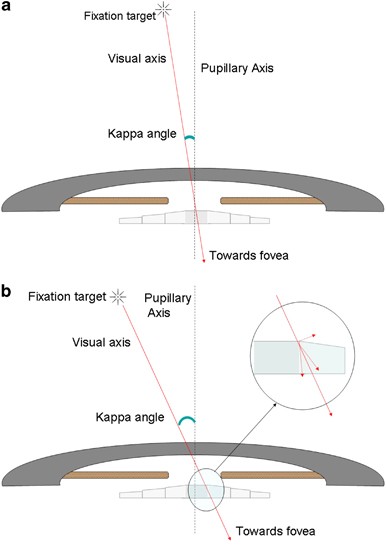 Predictive factor kappa angle analysis for visual in patients with multifocal IOL implantation |
