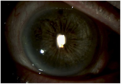Phacoemulsification with therapeutic implantation of a prosthetic iris  device following peripheral iridotomy visual complication | Eye