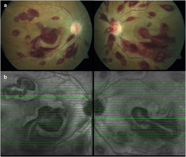 Spectral Domain Optical Coherence Tomography Of Roth Spots In Multiple Myeloma Eye