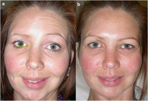 b12 injection cosmetic The Role of Vitamin B12 Injections in Enhancing Aesthetic Beauty