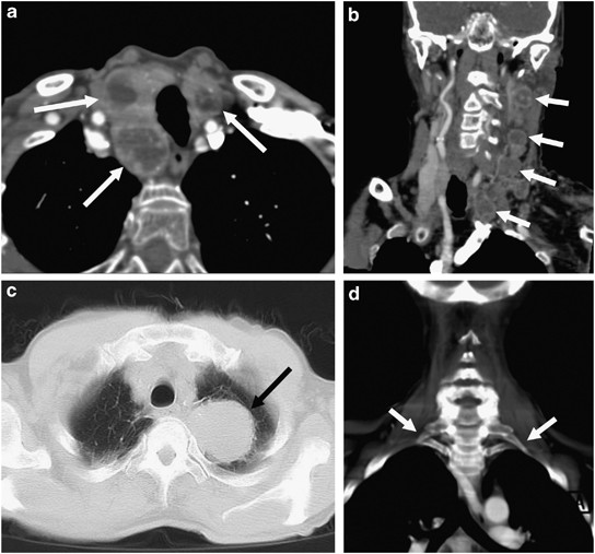 Adult Horner's syndrome: a combined clinical, pharmacological, and imaging  algorithm | Eye