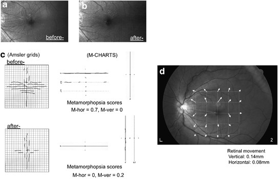 Quantification Of Changes In Metamorphopsia And Retinal