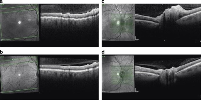 topomax choroidal effusion