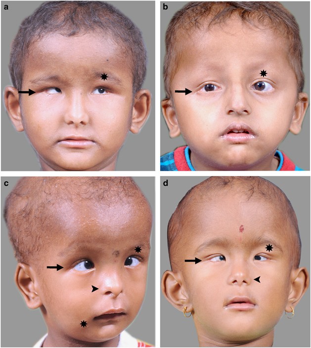 Hallermann Steriff Syndrome With Cutaneous Manifestations A