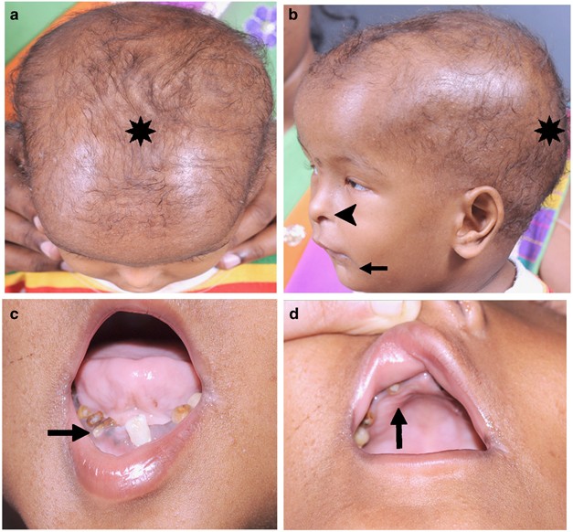 Ophthalmologic Manifestations Of Hallermann Streiff Francois Syndrome Report Of Four Cases Eye