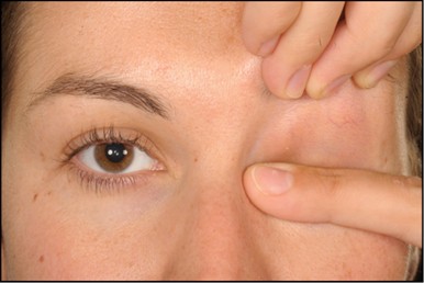 Occurrence And Severity Of Upper Eyelid Skin Contracture In Facial Nerve Palsy Eye