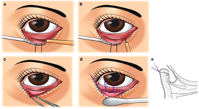 what is entropion surgery