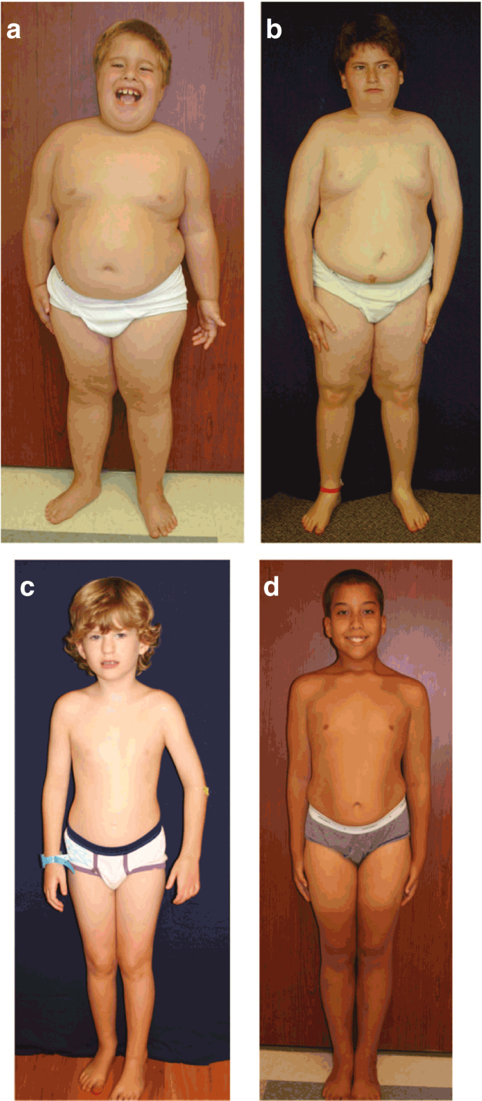 Prader-Willi syndrome | Genetics in Medicine