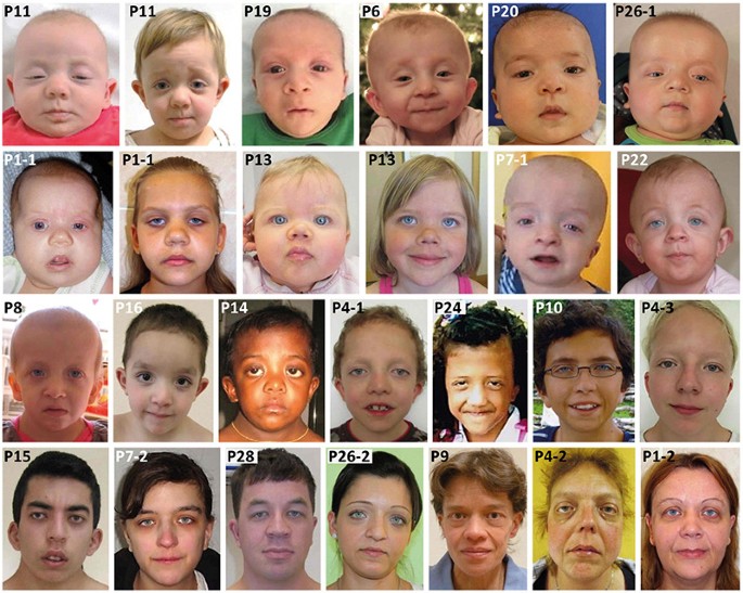 Genotype and phenotype in patients with Noonan syndrome and a RIT1 mutation  | Genetics in Medicine