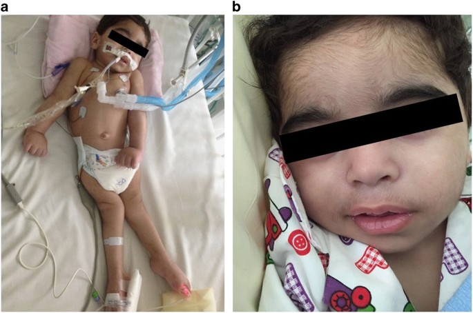 Early onset of Fazio-Londe syndrome: the first case report from the Arabian  Peninsula | Human Genome Variation