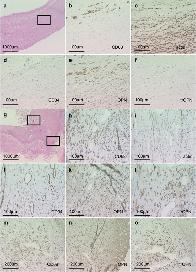 Plasma Thrombin Cleaved Osteopontin Elevation After Carotid Artery Stenting In Symptomatic Ischemic Stroke Patients Hypertension Research