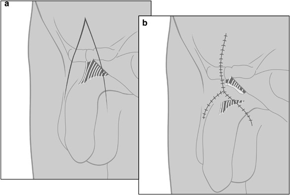 Penile size and penile enlargement surgery: a review | International  Journal of Impotence Research