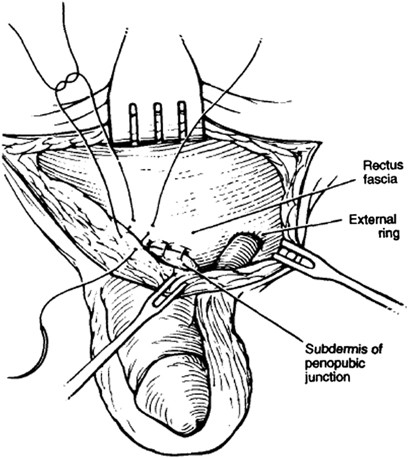 How To Make Pennis Thicker And Longer Naturally