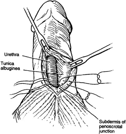 Penile size and penile enlargement surgery: a review | International  Journal of Impotence Research