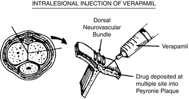 Peyronie