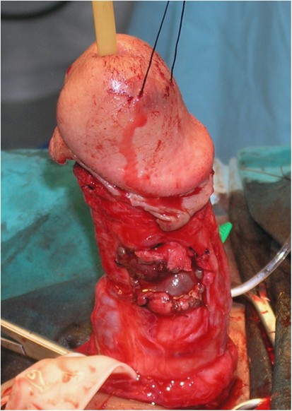 penis without skin 