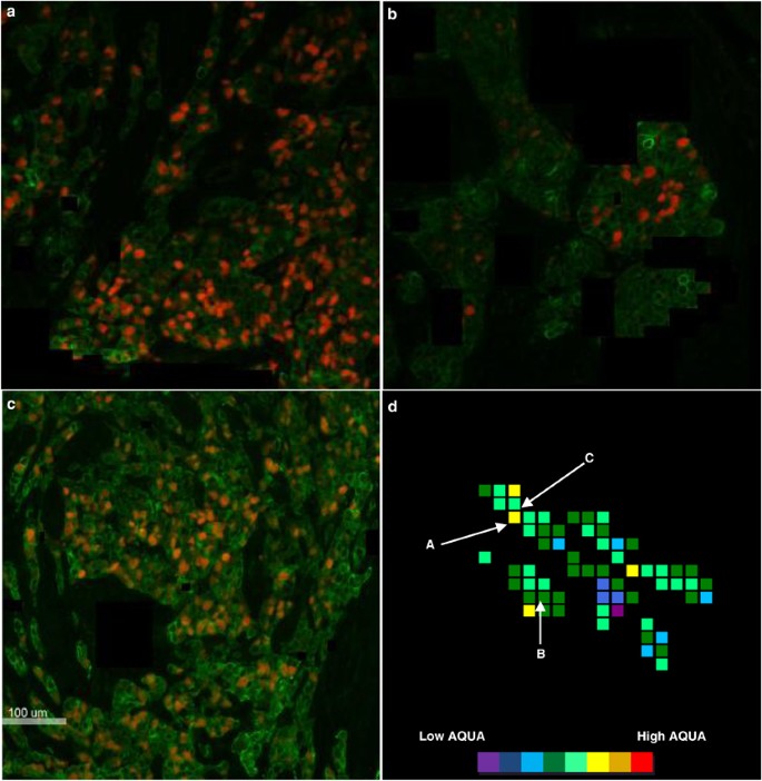 Quantitative assessment Ki-67 score for prediction of response to  neoadjuvant chemotherapy in breast cancer | Laboratory Investigation