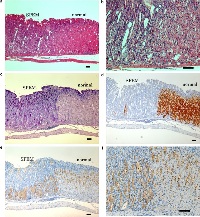 Emergence Of Spasmolytic Polypeptide Expressing Metaplasia In Mongolian Gerbils Infected With Helicobacter Pylori Laboratory Investigation