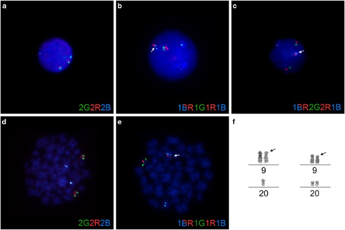 Detecting Dic 9 P13 2 P11 2 Positive B Cell Precursor Acute Lymphoblastic Leukemia In A Clinical Setting Using Fluorescence In Situ Hybridization Leukemia