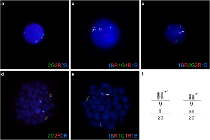 Detecting Dic 9 P13 2 P11 2 Positive B Cell Precursor Acute Lymphoblastic Leukemia In A Clinical Setting Using Fluorescence In Situ Hybridization Leukemia Detecting Dic 9 P13 2 P11 2 Positive B Cell Precursor Acute Lymphoblastic Leukemia In A Clinical Setting Using Fluorescence In Situ Hybridization Leukemia