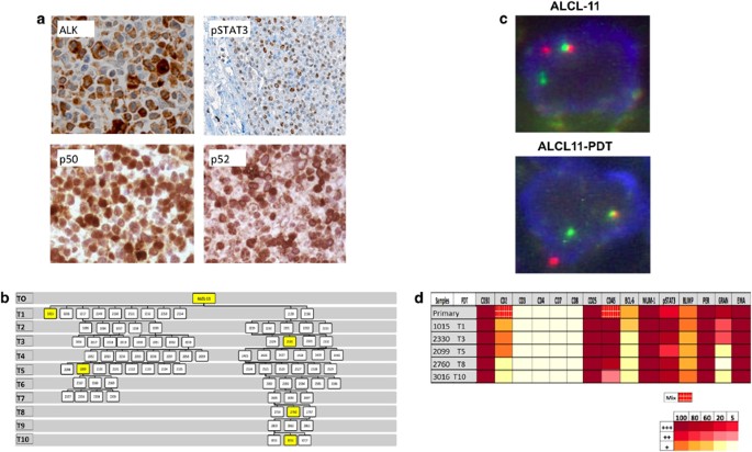 A novel patient-derived tumorgraft model with TRAF1-ALK anaplastic  large-cell lymphoma translocation | Leukemia