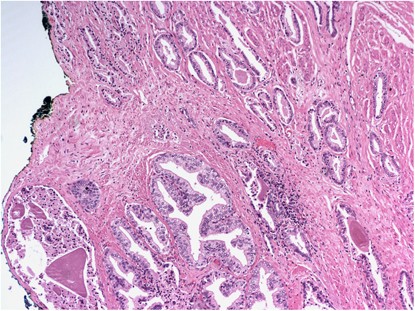 bladder neck involvement prostate cancer nemi betegségek férfiaknál képek